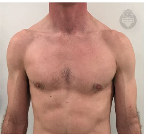 rupture of pectoralis major